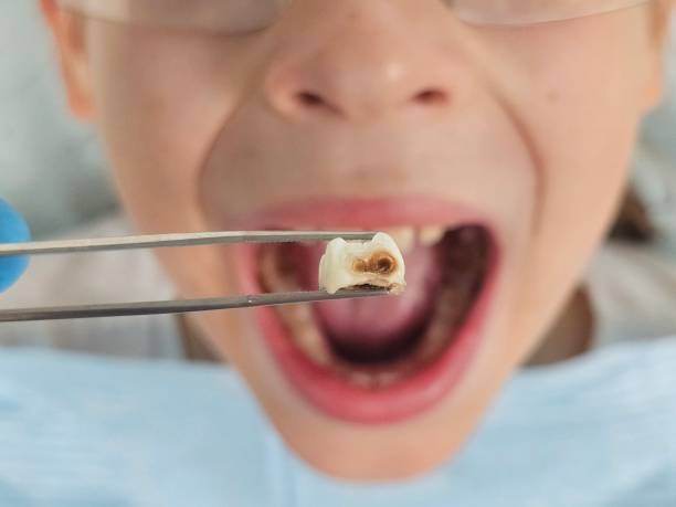 Best Emergency Dentist for Lost Fillings or Crowns in Shortsville, NY